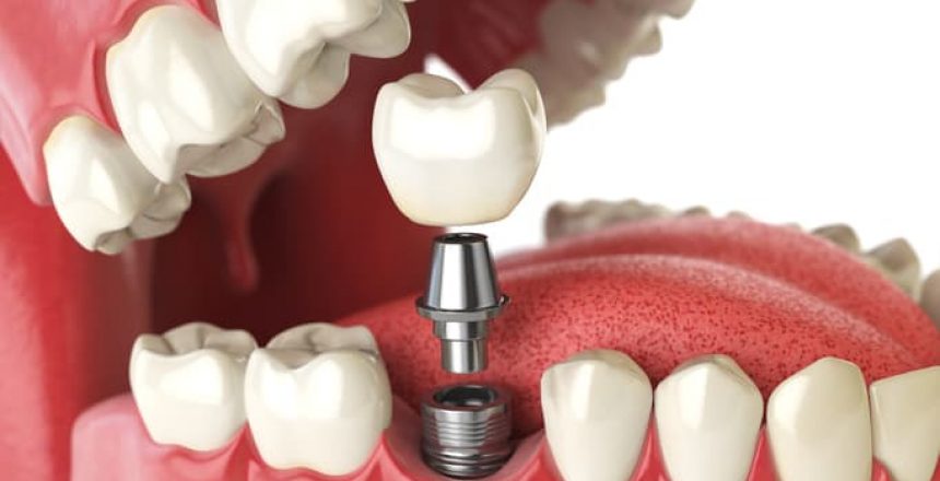 Bone-Grafting-for-Dental-Implants-san-diego